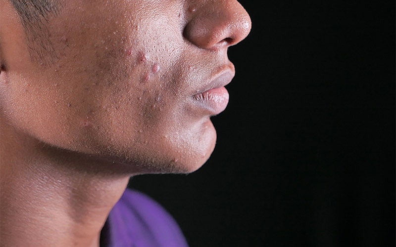 Roswell Acne Scar Removal model with acne.