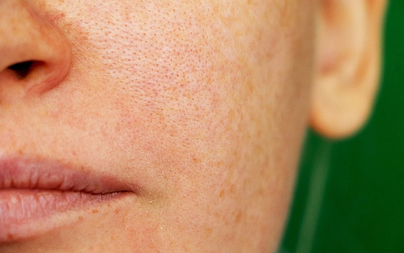 Roswell Melasma Treatment model's face close up