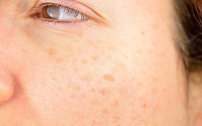 Roswell Sun Spot Removal model with brown eyes