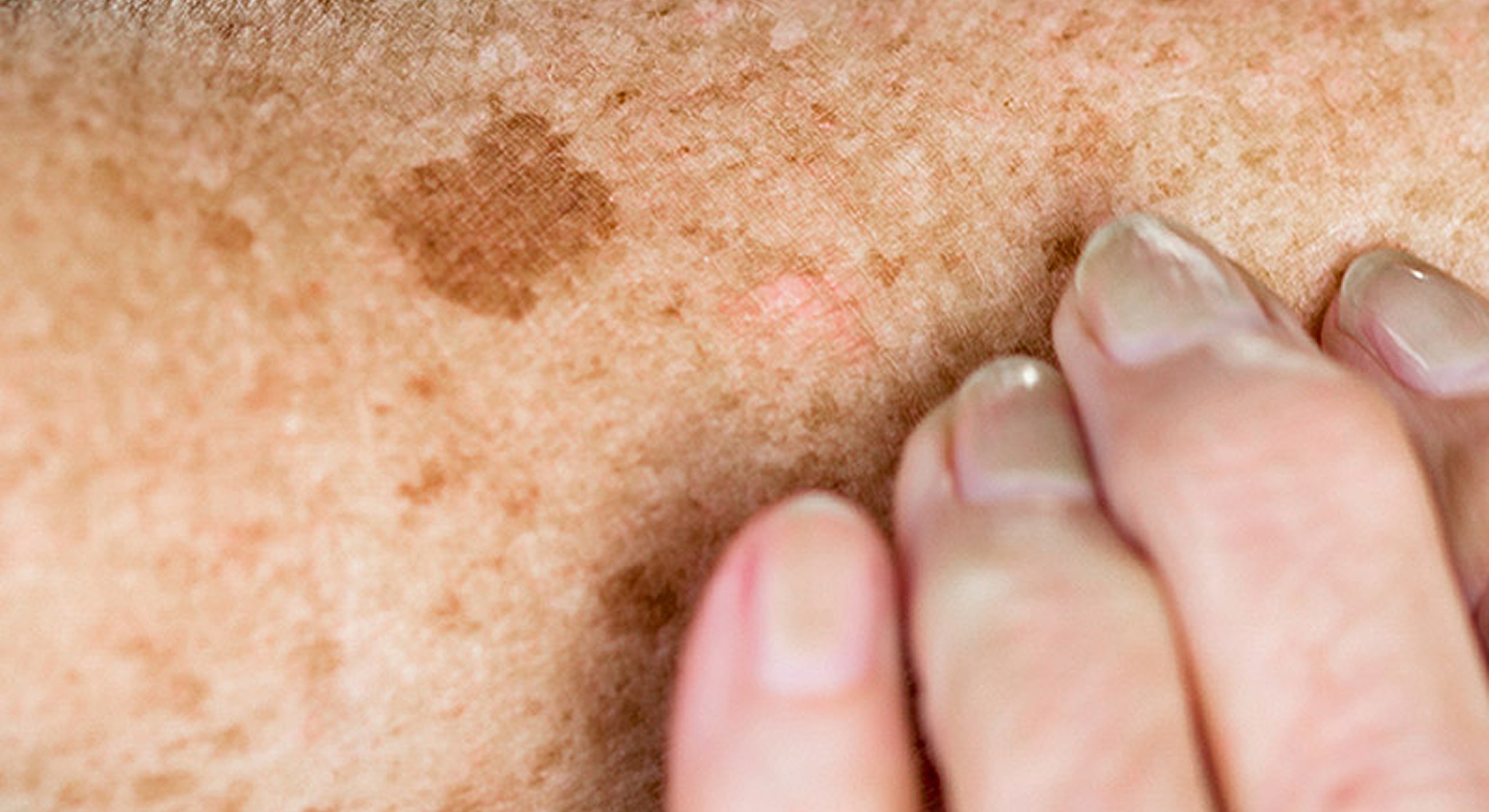 Roswell Age Spot Removal model showing age spots