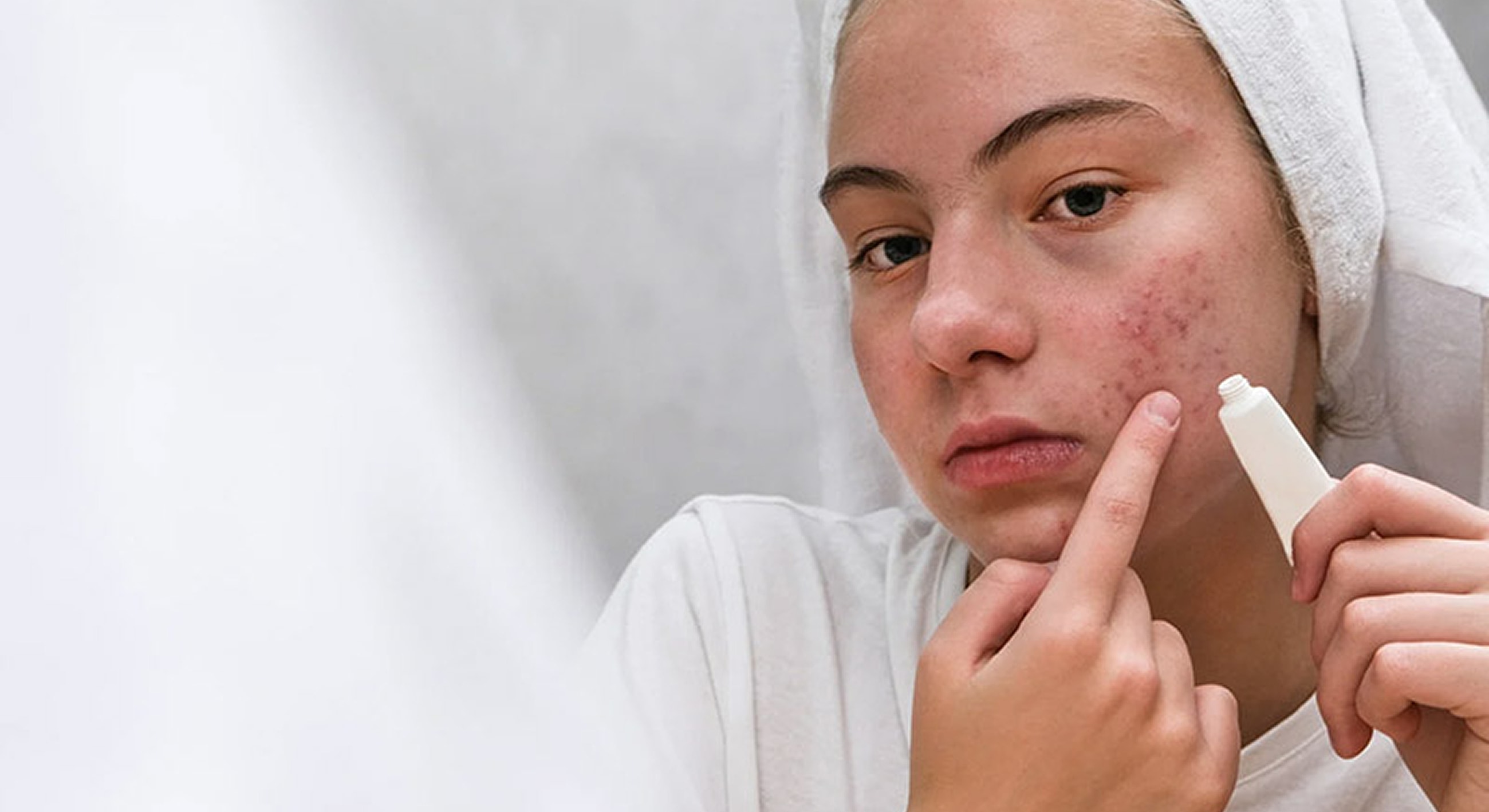 Roswell Blackhead Removal model applying skincare for acne treatment.