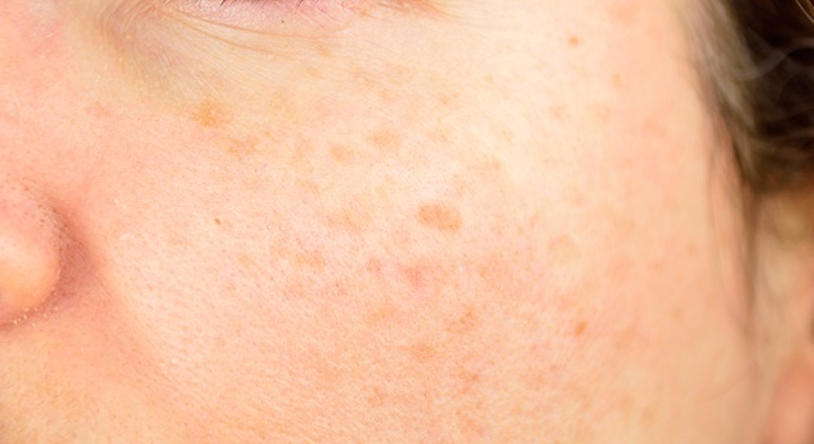 Roswell Brown Spot Removal model with brown hair
