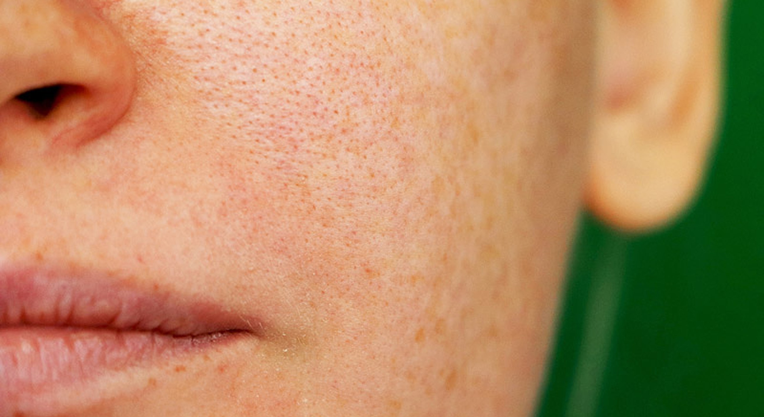 Roswell Melasma Treatment model's face close up