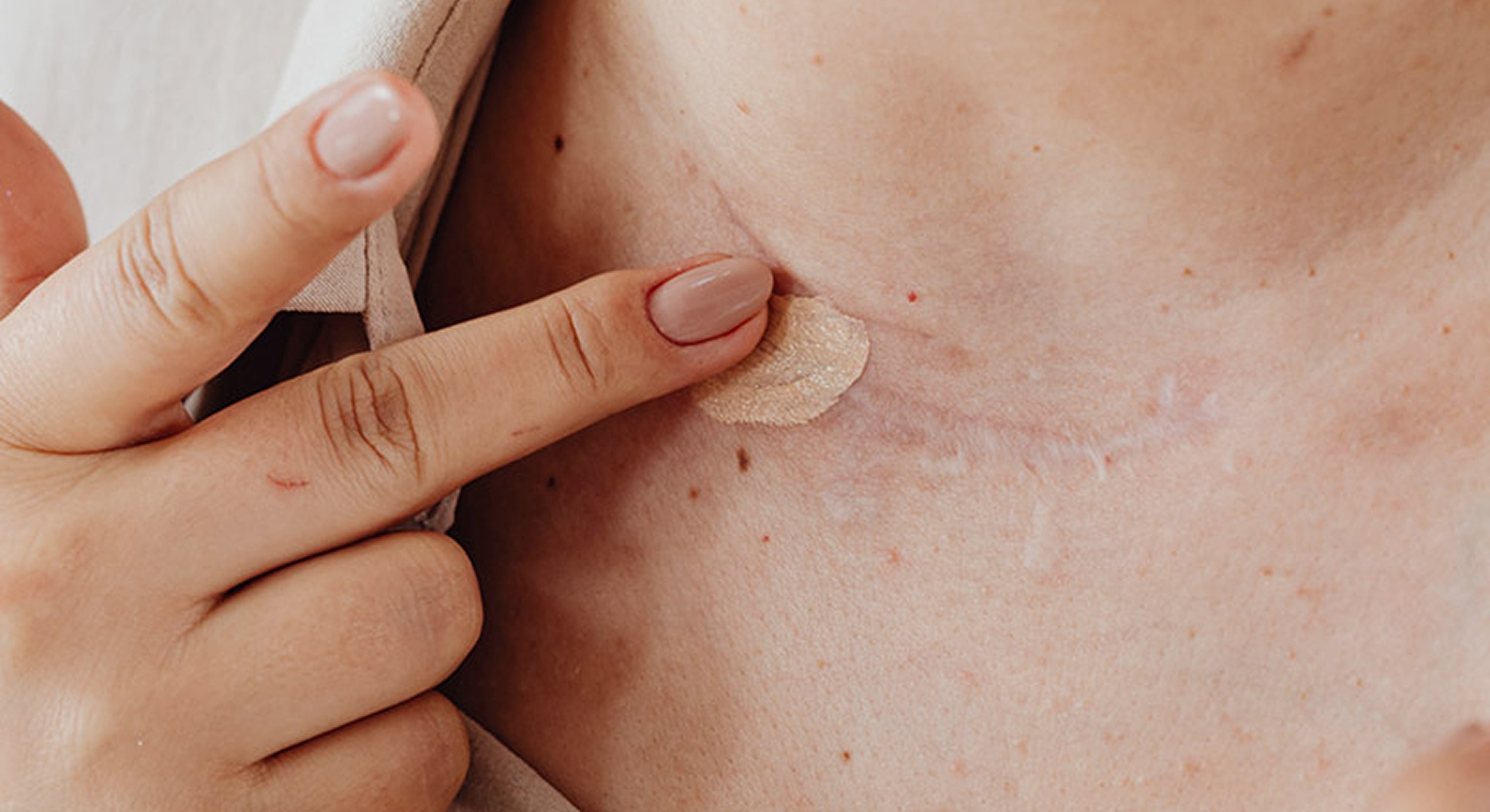 Roswell Scar Removal model touching scar